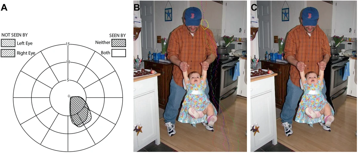 Visual field diagram and thin-man percept examples illustrating the scotoma carving hypothesis.