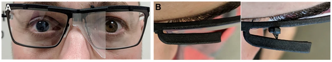 Clip-on multiplexing prism glasses fitted to a participant with acquired monocular vision.